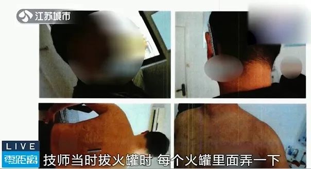 获赔21万！男子拔火罐致二度烧伤、十级残疾，或需植皮治疗