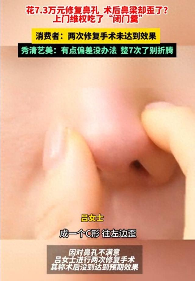 女子花数万修复鼻孔却被弄歪鼻梁