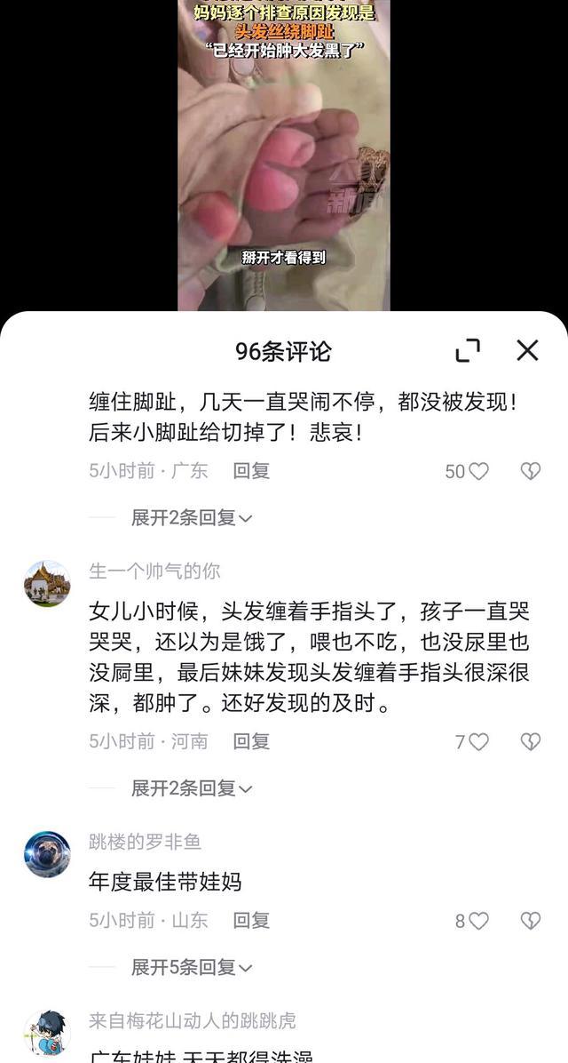 女婴哭闹不止竟头发丝绕脚趾 家长细心检查避免悲剧